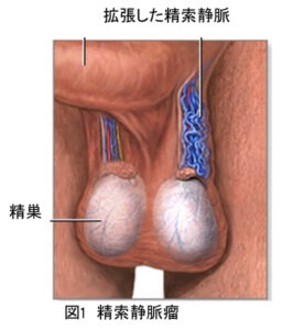 精巣静脈瘤の参考図